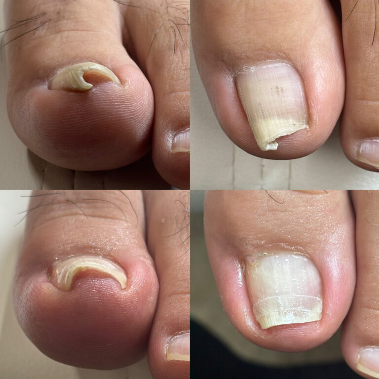 左親指